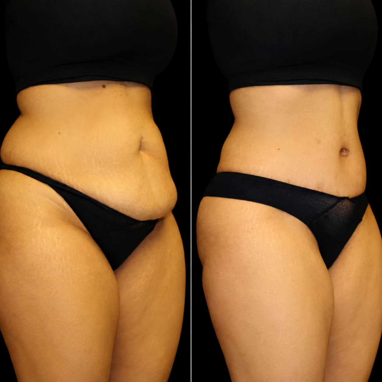 Sculpt Ultra